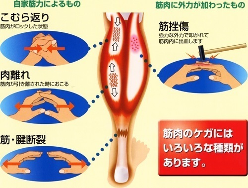 肉離れとは