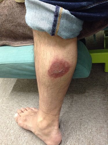 コールドスプレーによる凍傷