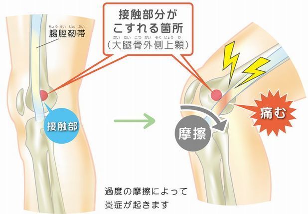 腸脛靭帯炎のメカニズム